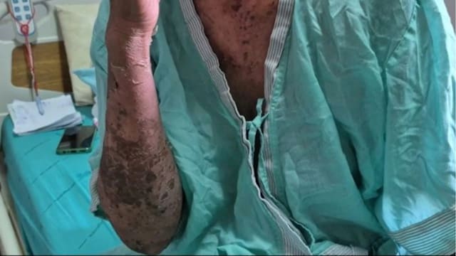 误信偏方能治带状疱疹 泰国女菜贩险些丧命