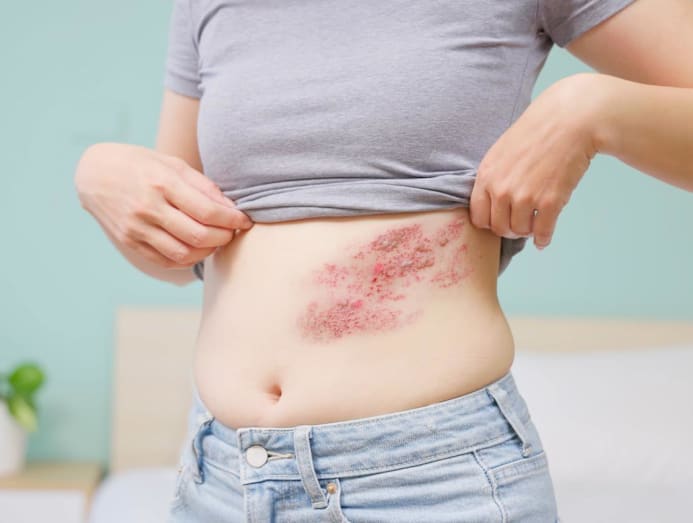 shingles-vaccine-heart-attack-stroke-benefit_6.jpg