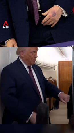 Trump attributes new bruise on hand to aspirin consumption