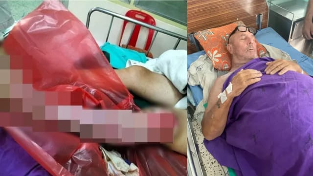 疑在泰国被蝎子蛰伤 英国男皮肉溃烂需截肢保命