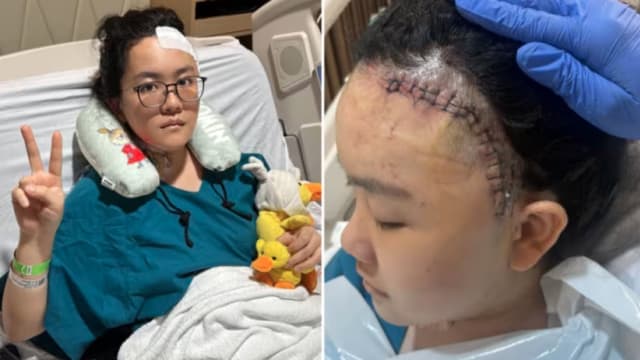 26岁女子突然头剧痛  被诊断脑血管破裂引发中风  