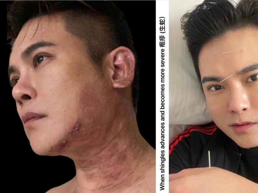 “My doctor says I can't return to acting...unless I play a stroke victim”: ex-Mediacorp actor Nick Shen on getting shingles and then Bell’s Palsy