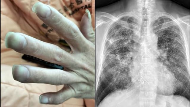 台男子不抽烟出现“杵状指”   X光检查照出密集肺结节