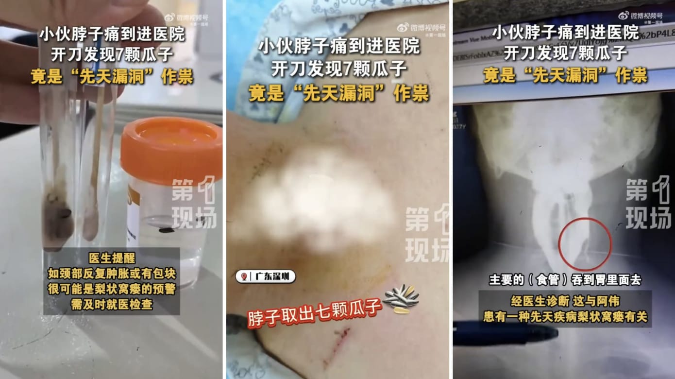 中国男脖子肿痛开刀 竟取出20年前吃的七颗瓜子