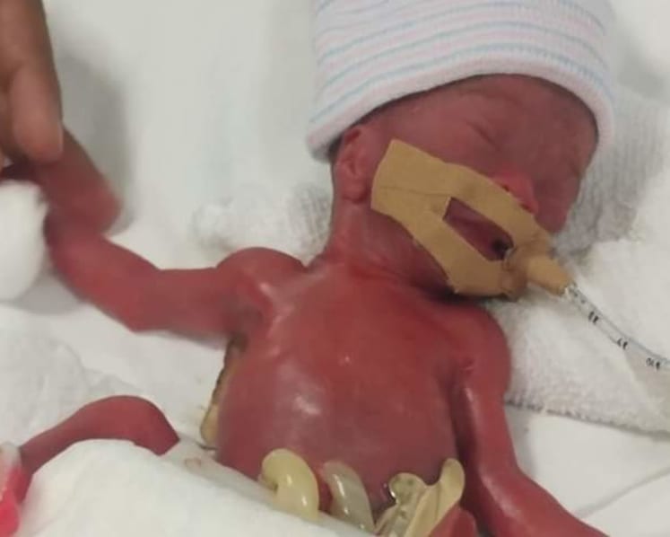 World’s smallest baby, born at 212 grams at NUH, now doing well at 14 months old