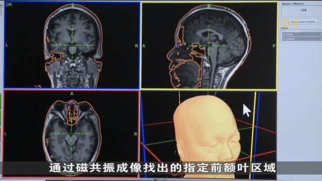 医疗团队展开临床试验 治疗难治型抑郁症患者
