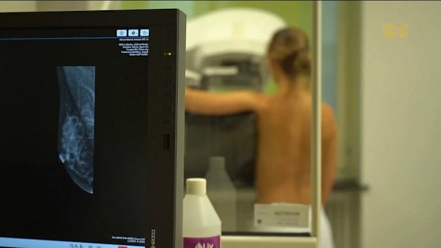 瑞典临床试验：AI辅助乳癌筛查有助及早发现癌症