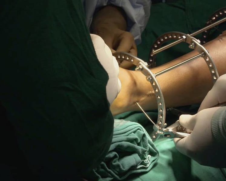 Is bone-breaking surgery to grow taller worth the risk?