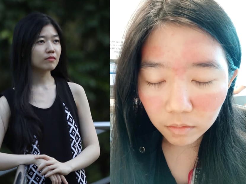 Gen Y Speaks: What dealing with my skin problems taught me