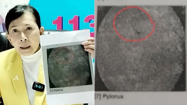 生产时医疗针头不慎掉入阴道 泰女忍痛18年