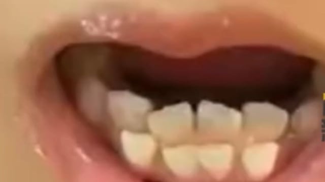 饮食过于精细 中国六岁女童长出双排牙