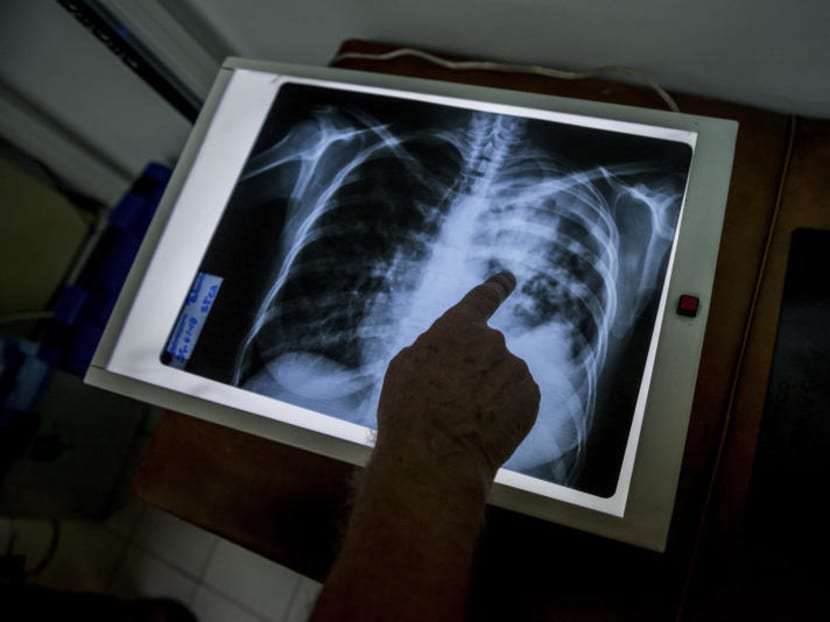 Strategies used in tackling Covid-19 can help to eliminate TB in S’pore