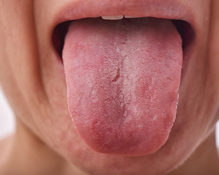 What’s that white coating on your tongue? How to tell if you’re healthy or not