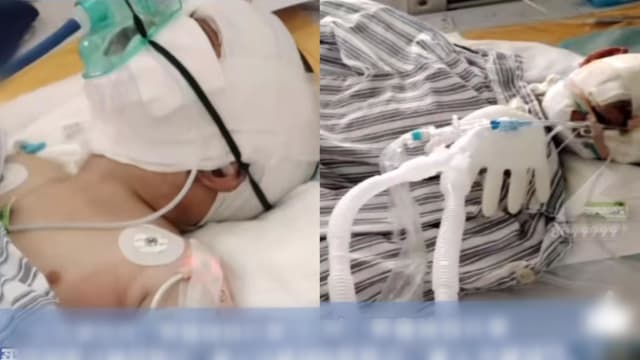 爷爷外出买菜 中国三岁男童在睡梦中被烧成重伤