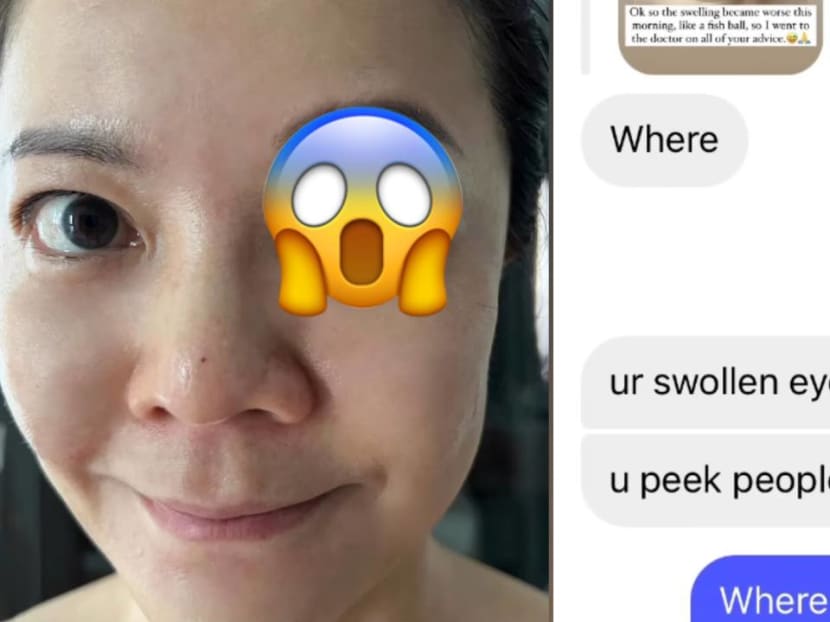 Michelle Chong has a horrifying swollen eye; gives hilarious reply to follower who asked if she peeped at someone in the shower