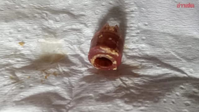 泰国男童“鼻窦炎”近十年 母亲惊揭原来是铅笔卡鼻孔
