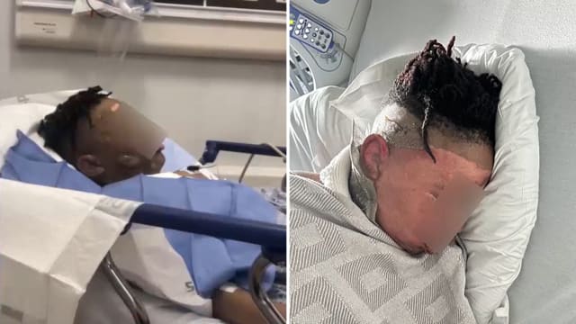 睡觉遭朋友恶作剧用热水泼脸 美国男童近乎毁容