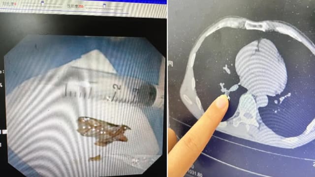 睡觉时将蟑螂吸入气管 中国男子频咳嗽嘴有臭味