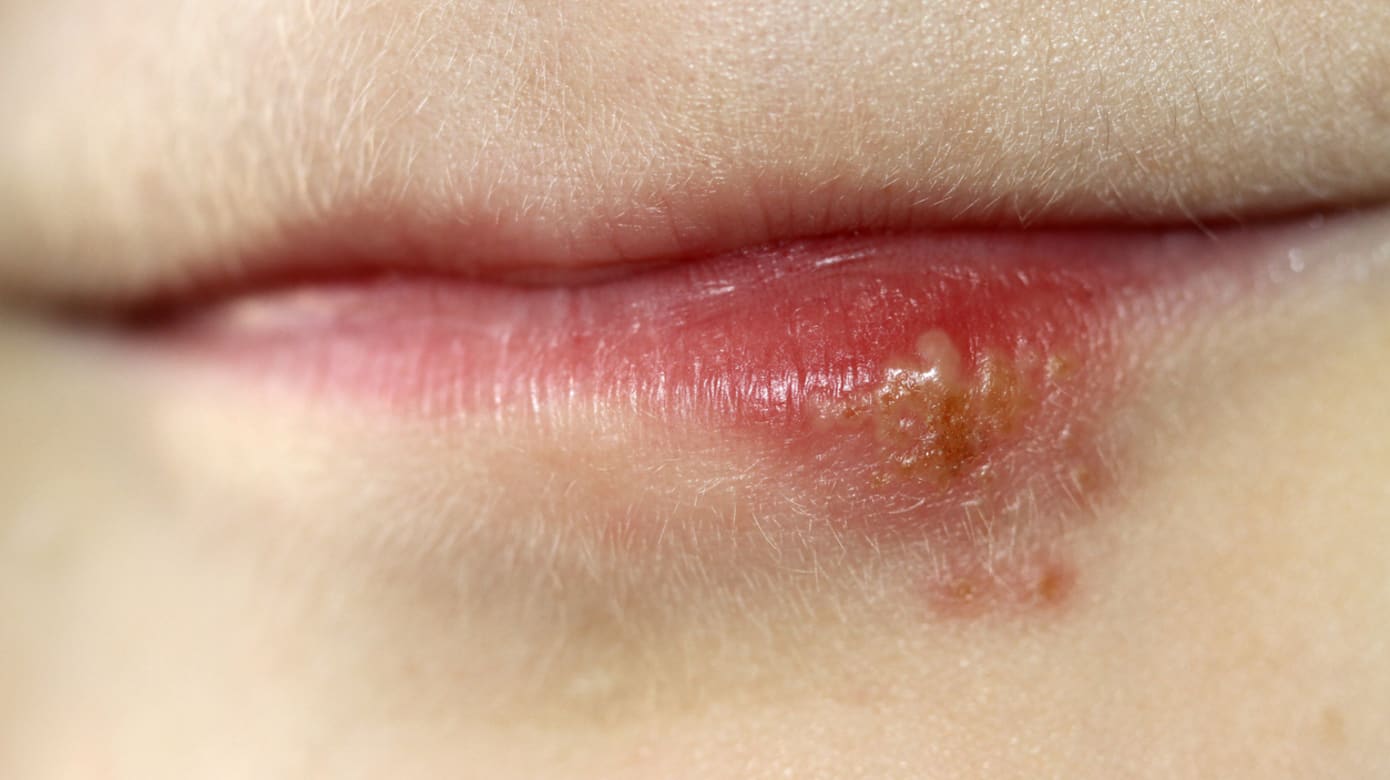 嘴角起泡误当上火 中国女子高烧呕吐后脑死