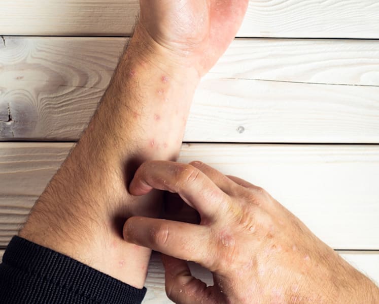 Alleviating the pain of psoriasis and psoriatic arthritis