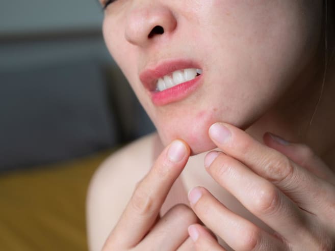 What is hormonal acne and why do some women battle it into adulthood?