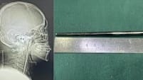 Man Lives With 12cm Metal Chopstick In Throat For 8 Years
