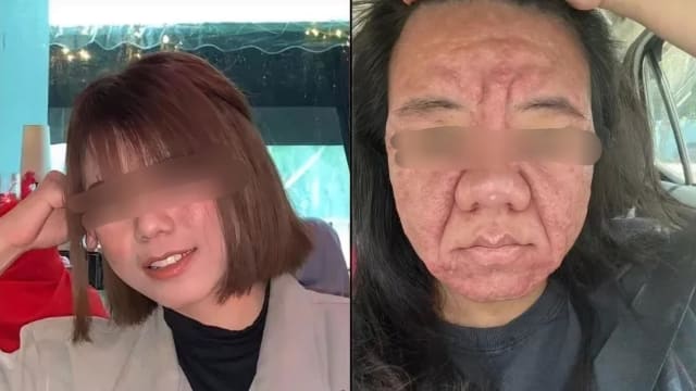 马国孕妇因怀孕严重爆痘 勇敢分享经历获网民打气  