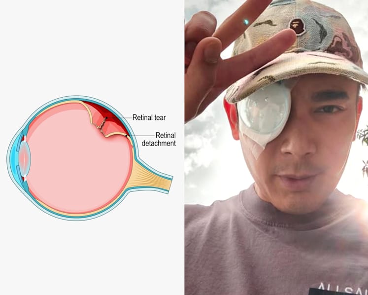Elvin Ng’s eye surgery: Retinal detachment, myopia and the warning signs you should not ignore