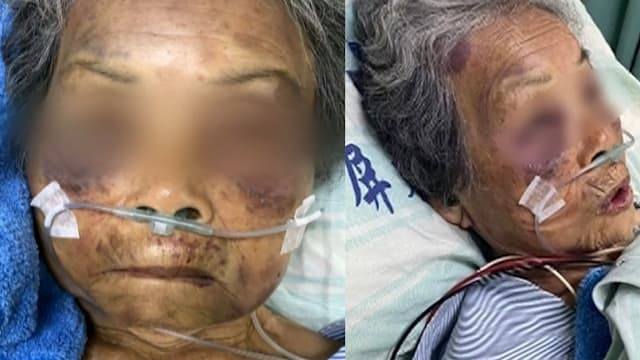 台屏东逆孙讨不到钱施暴  九旬嫲脑出血送医