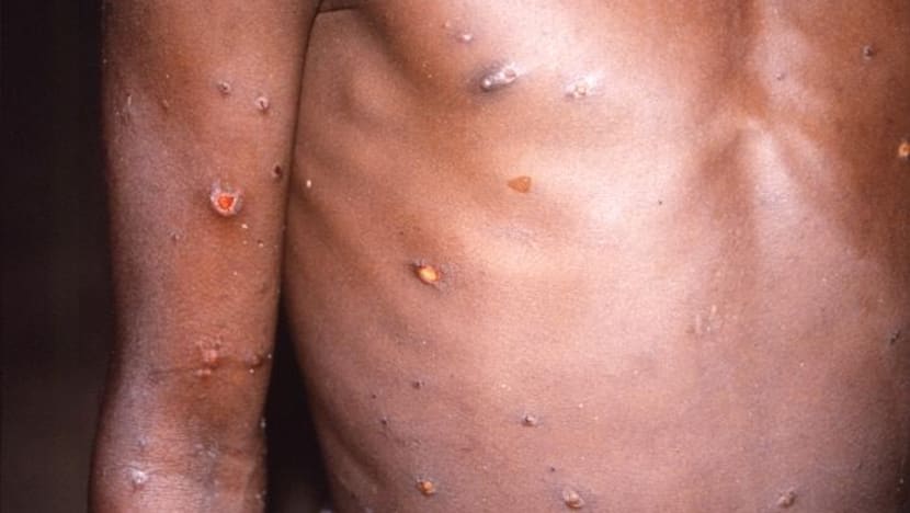 Monkeypox case: All-clear given by MOH for 22 people in close contact with patient