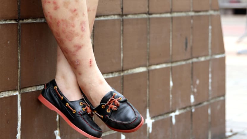 Tackling that itch: Demand for help with skin issues on the rise in Singapore