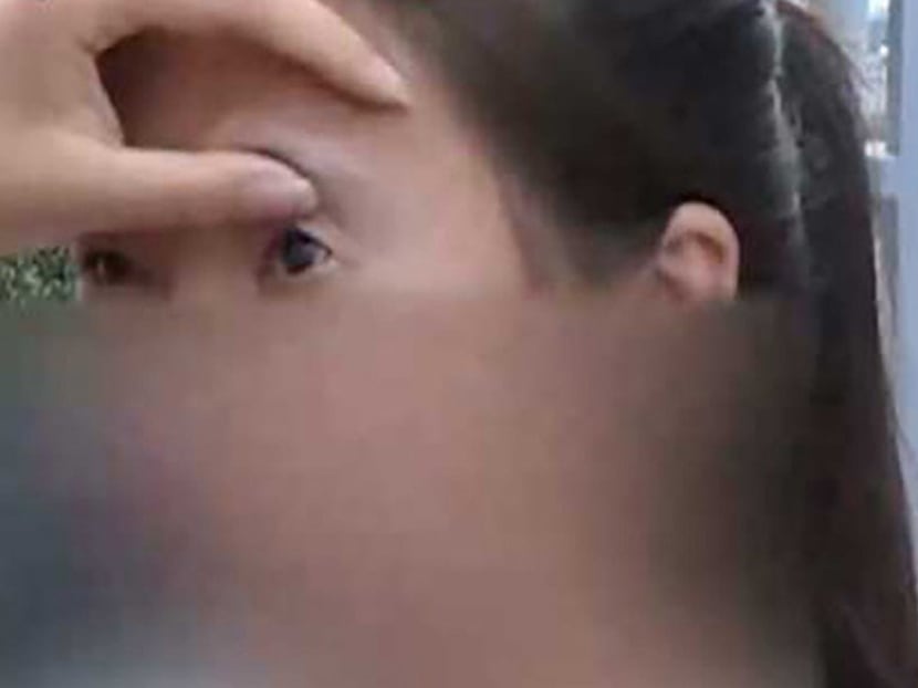 Xiaobai, 18, had cosmetic surgery a year, but it left her with severe pain and unable to fully use one of her eyelids.