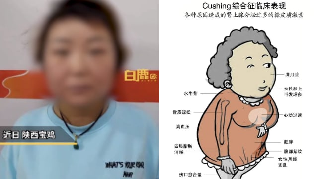 颜值暴跌是因为年纪大？ 中国女子求医后发现患罕见病
