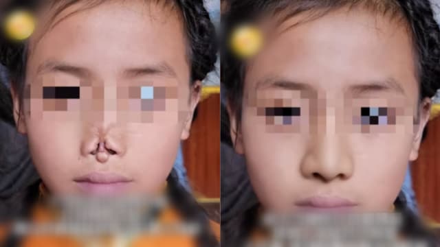遭黄鼠狼咬掉鼻子 中国两孩童靠3D重建获新鼻