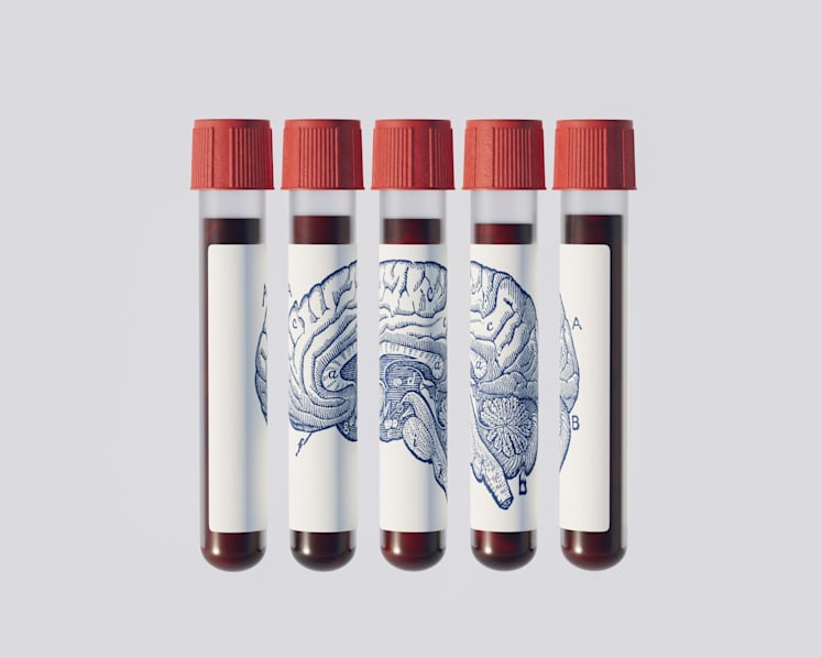 Could a blood test predict if you’ll get Alzheimer’s years before symptoms appear?