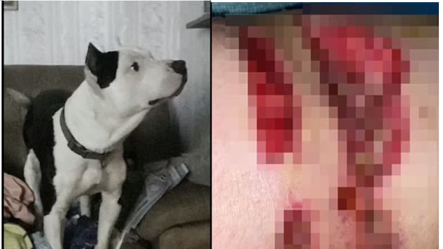 养比特犬看家 少女被爱犬攻击差点失去一条腿