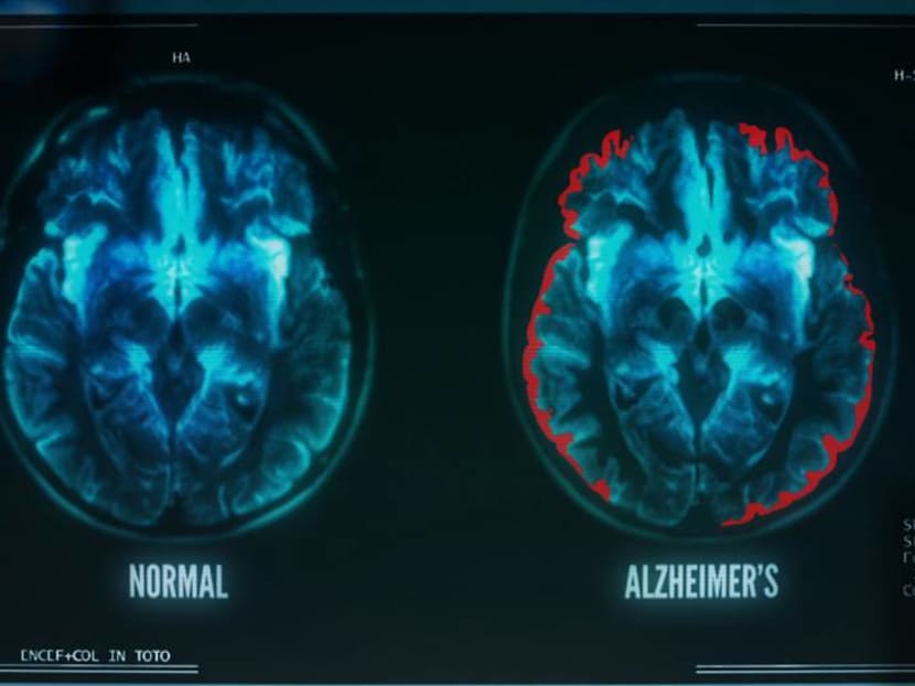 Commentary: Hard to grapple with dementia when early signs are often neglected