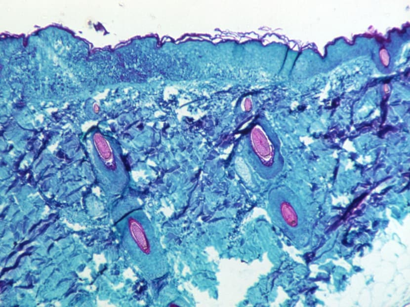 A section of skin tissue, harvested from a lesion on the skin of a monkey, that had been infected with monkeypox virus, is seen at 50X magnification on day four of rash development in 1968. A section of skin tissue, harvested from a lesion on the skin of a monkey, that had been infected with monkeypox virus, is seen at 50X magnification on day four of rash development in 1968.