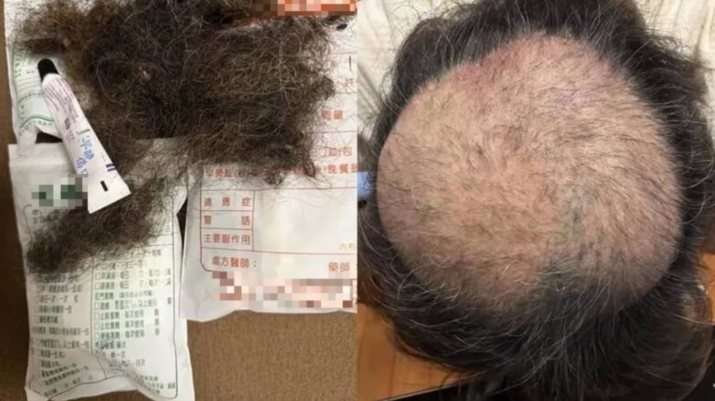 难忍臭豆腐气味 台北男子焦虑狂拔头发