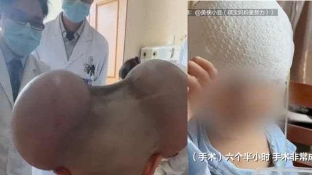 曾被讥笑“像米老鼠”   中国三岁童头部“巨痣”成功切除