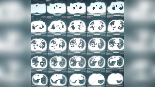 一天抽200支烟 中国男子双肺千疮百孔溃烂 
