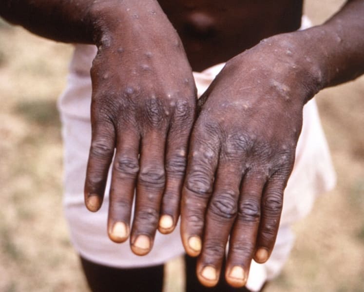 Commentary: Four ways the monkeypox outbreak can play out