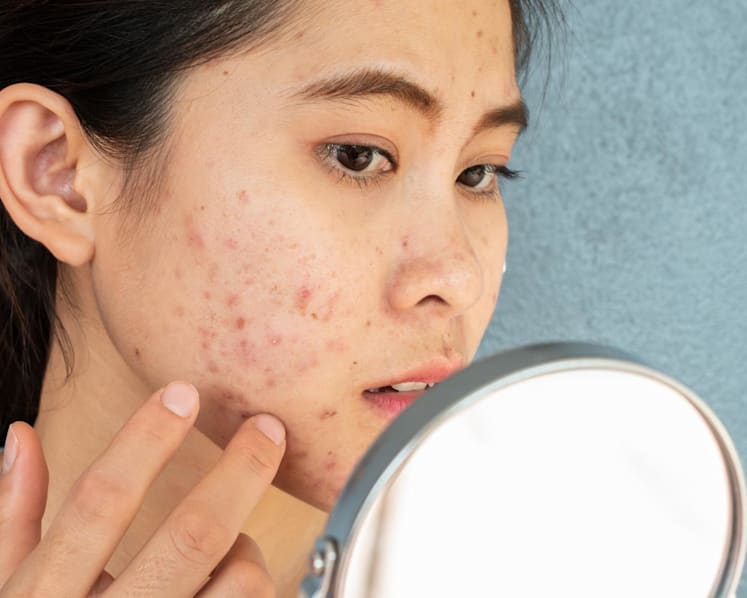 Here’s why misusing acne medications might make your body resistant to antibiotics 