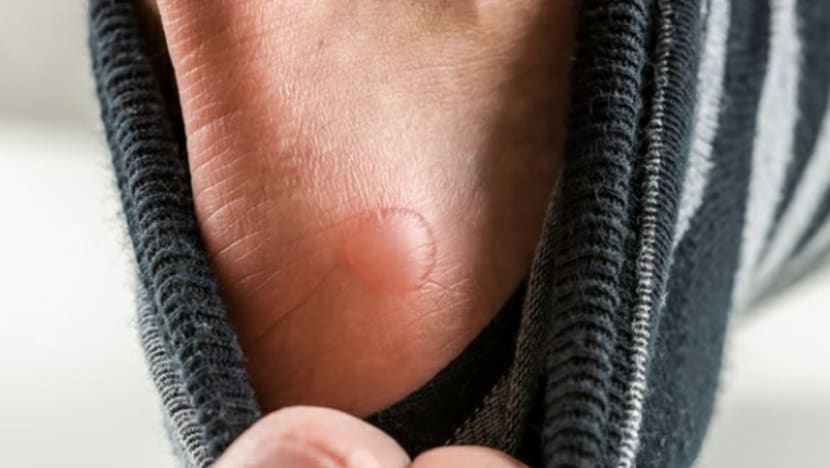 4 bahan di rumah ini boleh digunakan untuk atasi masalah kutu air