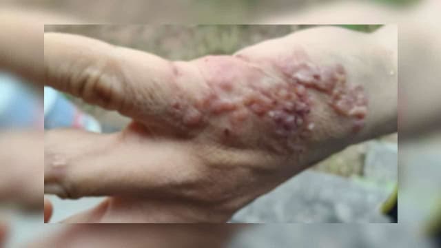 泰男手部皮肤长神秘水泡 医生解惑钩虫幼虫所致