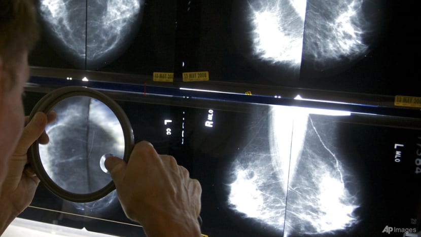 Commentary: AI improves breast cancer detection, but will that save lives? Commentary: AI improves breast cancer detection, but will that save lives?