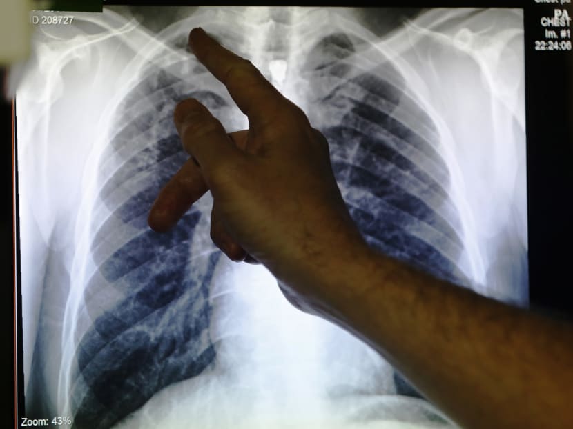 Is it time to reevaluate S’pore’s TB treatment strategy? Is it time to reevaluate S’pore’s TB treatment strategy?