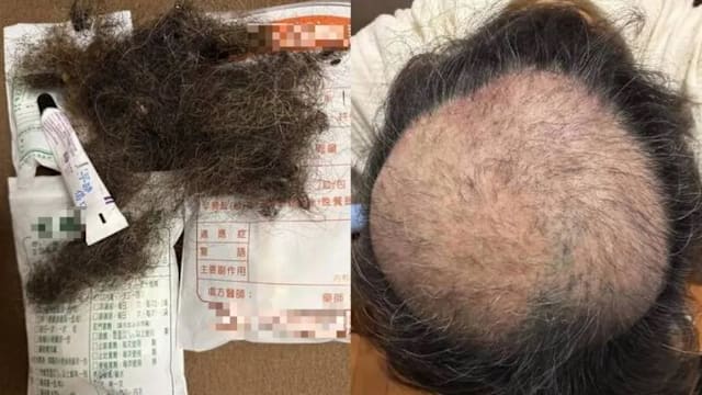 难忍臭豆腐气味 台北男子焦虑狂拔头发