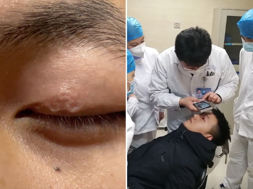 #trending: Man with parasitic worms under eyelid asks internet for help after doctors say they can't treat him