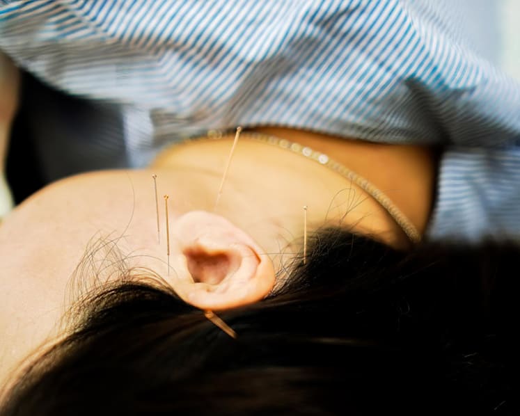 TCM practitioner suspended after needles left in patient's head, toe following acupuncture treatment